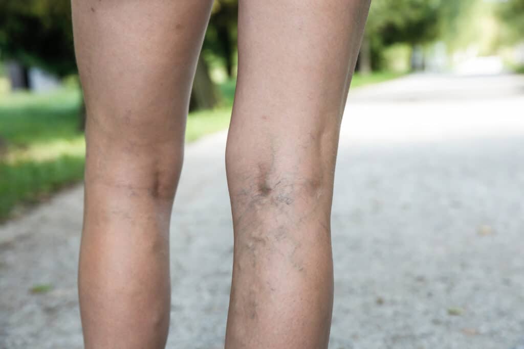 Visible spider veins behind the knee