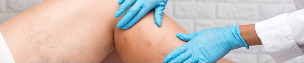 Vein care